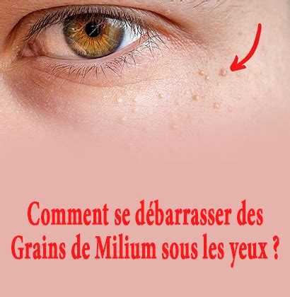 Comment se débarrasser des grains de Fordyce: 12 étapes